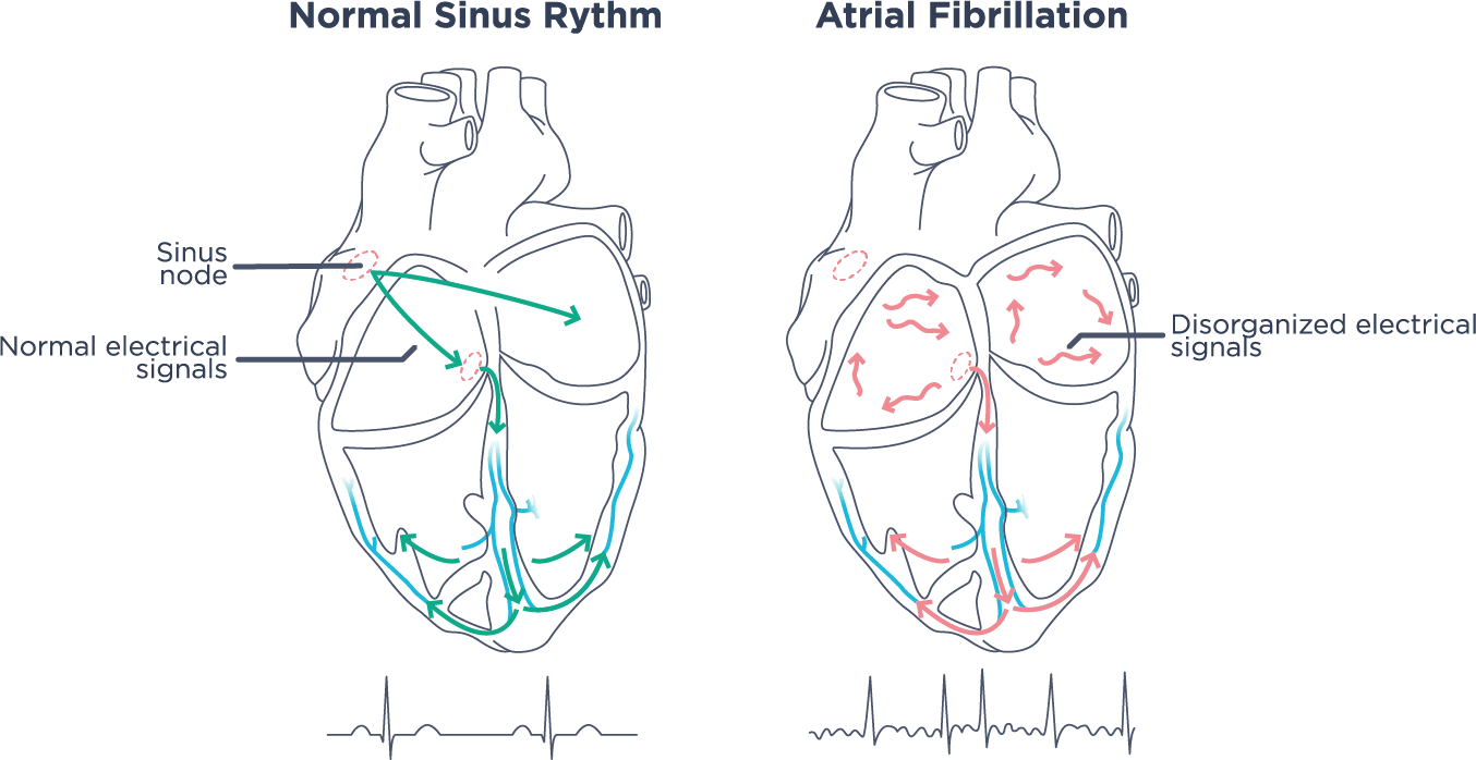 Heart - Atrial Fibrillation